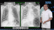Dr.長尾の胸部X線ルネッサンス | 第4回　横隔膜の動きに注目する