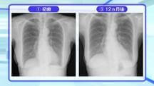 Dr.長尾の胸部X線クイズ　中級編 | 第5回　あの疾患の超初期像はこう見える