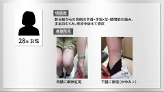 一発診断 | 第6回　両側の手足に皮疹、むくみ、関節痛を訴える28歳女性