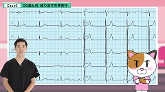 Dr.増井の心電図ハンティング2　失神・不整脈編 | 第2回　P 波が繋がっているから大丈夫？