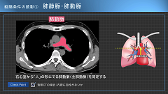 呼吸器内科医Kのイメージと病態がつながる胸部CTの読み方 | 第2回　縦隔条件 