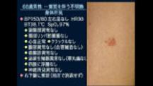 Dr.岩田のFUO不明熱大捜査線 | 第13回 膠原病 case3 ―68歳男性・・紫斑を伴う不明熱―