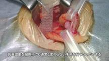 Dr.みやざきの鼠径ヘルニア手術テクニックコレクション | 第4回　鼠径部ヘルニア手術の術前・術後管理