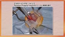 Dr.みやざきの鼠径ヘルニア手術テクニックコレクション | 第8回　手術手技の実際（３）　Lichtenstein法