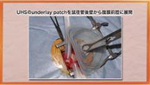 Dr.みやざきの鼠径ヘルニア手術テクニックコレクション | 第9回　手術手技の実際（４）　UHS法