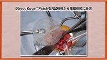 Dr.みやざきの鼠径ヘルニア手術テクニックコレクション | 第10回　手術手技の実際（５）　Direct Kugel Patch法
