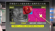 Dr.小川のアグレッシブ腹部エコー　肝臓編 | 第4回　肝腫瘤性病変と肝細胞がん1　－基本を押さえる－