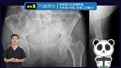 Dr.増井の骨折ハンティング | 第3回　股関節痛Part2