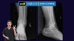 Dr.増井の骨折ハンティング | 第6回　足関節痛