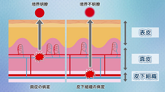 Dr.松田のフローチャート皮膚診断 | 第4回　真皮の病変(1) 蕁麻疹の鑑別と中毒疹の考え方