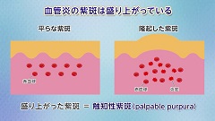 Dr.松田のフローチャート皮膚診断 | 第7回　紫斑