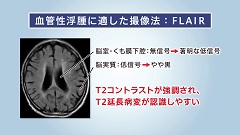 ユキティ先生の救急MRI読影教室 | 第6回　血管性浮腫