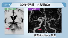 ユキティ先生の救急MRI読影教室 | 第7回　診断に役立つMRIの現象(1)　flow void