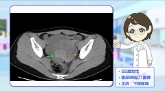 Dr.金井のCTクイズ　中級編 | 第12回　腹部（女性生殖器）：単純CTの重要性！水の違いに気付くかな？