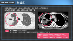 呼吸器内科医Kのイメージと病態がつながる胸部CTの読み方 | 第4回　結節影・腫瘤影