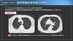 呼吸器内科医Kのイメージと病態がつながる胸部CTの読み方 | 第6回　肺の構造破壊が主体の病変