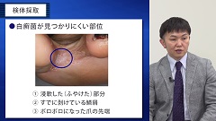 プライマリ・ケアの疑問　Dr.前野のスペシャリストにQ 皮膚科編 | 第10回　足白癬の検査・診断