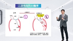 Dr.香坂の循環器診療フロントライン | 第6回　大動脈弁狭窄（AS）・僧帽弁逆流症（MR）