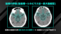 Dr.和田の救急頭部CT読影の鉄則 | 第2回　救急頭部CT読影の鉄則 (3) (4)