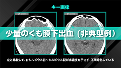 Dr.和田の救急頭部CT読影の鉄則 | 第4回　急激な頭痛増悪の原因は？