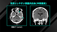 Dr.和田の救急頭部CT読影の鉄則 | 第6回　頭部外傷での見落としを防げ！