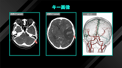 Dr.和田の救急頭部CT読影の鉄則 | 第7回　意識障害の原因を探れ！