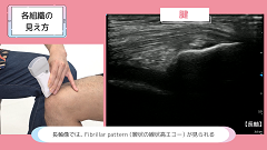 Dr.わへいの在宅エコー　いろはにほへ | 第3回　運動器エコー