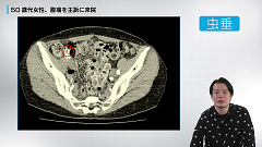 Dr.青柳の急性腹症CT読影 実況中継 | 第2回　最もコモンな原因疾患