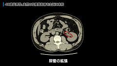 Dr.青柳の急性腹症CT読影 実況中継 | 第4回　痛みを生む「石」の見つけ方