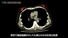 Dr.青柳の急性腹症CT読影 実況中継 | 第5回　腫大している臓器の評価