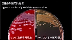 Dr.岡とMT佐々木の感染症プラチナレクチャー　臨床微生物編 | 第4回　クレブシエラ・ニューモニエ（肺炎桿菌）