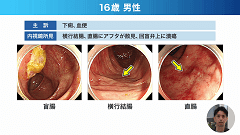 Dr.松本の消化管ベストプラクティス | 第4回　潰瘍性大腸炎