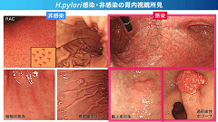 Dr.松本の消化管ベストプラクティス | 第6回　消化性潰瘍