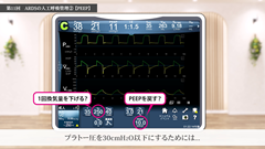 Dr.Junの人工呼吸管理スピードマスター | 第11回　ARDSの人工呼吸管理(2) PEEP