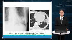 研修医のための画像診断 | 第2回　胸部X線　実践編