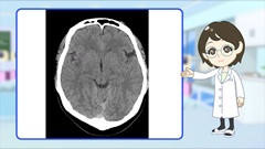 Dr.金井のCTクイズ　上級編 | 第1回　頭部：Neurological Emergency 急げ次の一手は？