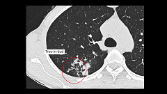 研修医のための画像診断 | 第10回 胸部CT 実践編 研修医のための画像診断 | 第10回 胸部CT 実践編