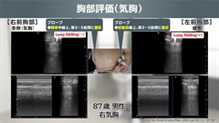 Dr.瀬良の救急エコーEFASTインストラクション | 第8回　胸部評価（気胸）