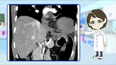 Dr.金井のCTクイズ 上級編 | 第6回 胸腹部:つながっているかをよーく見てみよう Dr.金井のCTクイズ 上級編 | 第6回 胸腹部:つながっているかをよーく見てみよう
