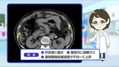 Dr.金井のCTクイズ　上級編 | 第12回　腹部：airの原因は？先入観にとらわれない