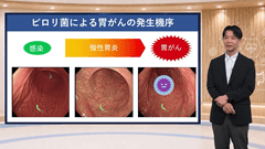 Dr.平澤のよくわかる上部消化管内視鏡 | 第3回　胃がんの診断と内視鏡治療