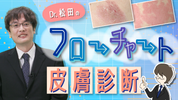 Dr.松田のフローチャート皮膚診断 | 第2回　表皮の病変(1) 湿疹と白癬の鑑別